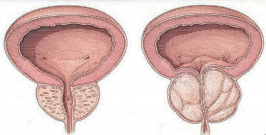 prostata-hbp-formulacion-magistral-laboratorio-perello